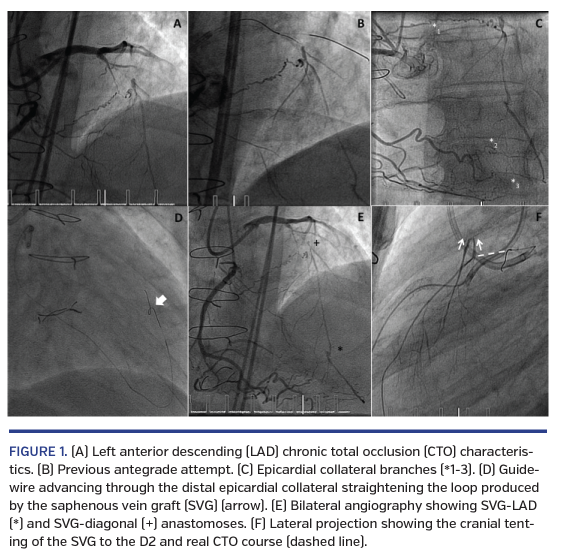 Coronary Artery Tenting After Bypass Grafting A Key Issue During